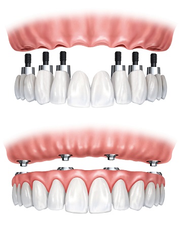 Implant full arch