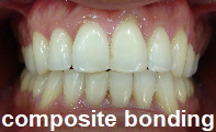 composite bonding