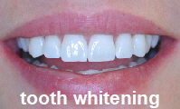 tooth whitening